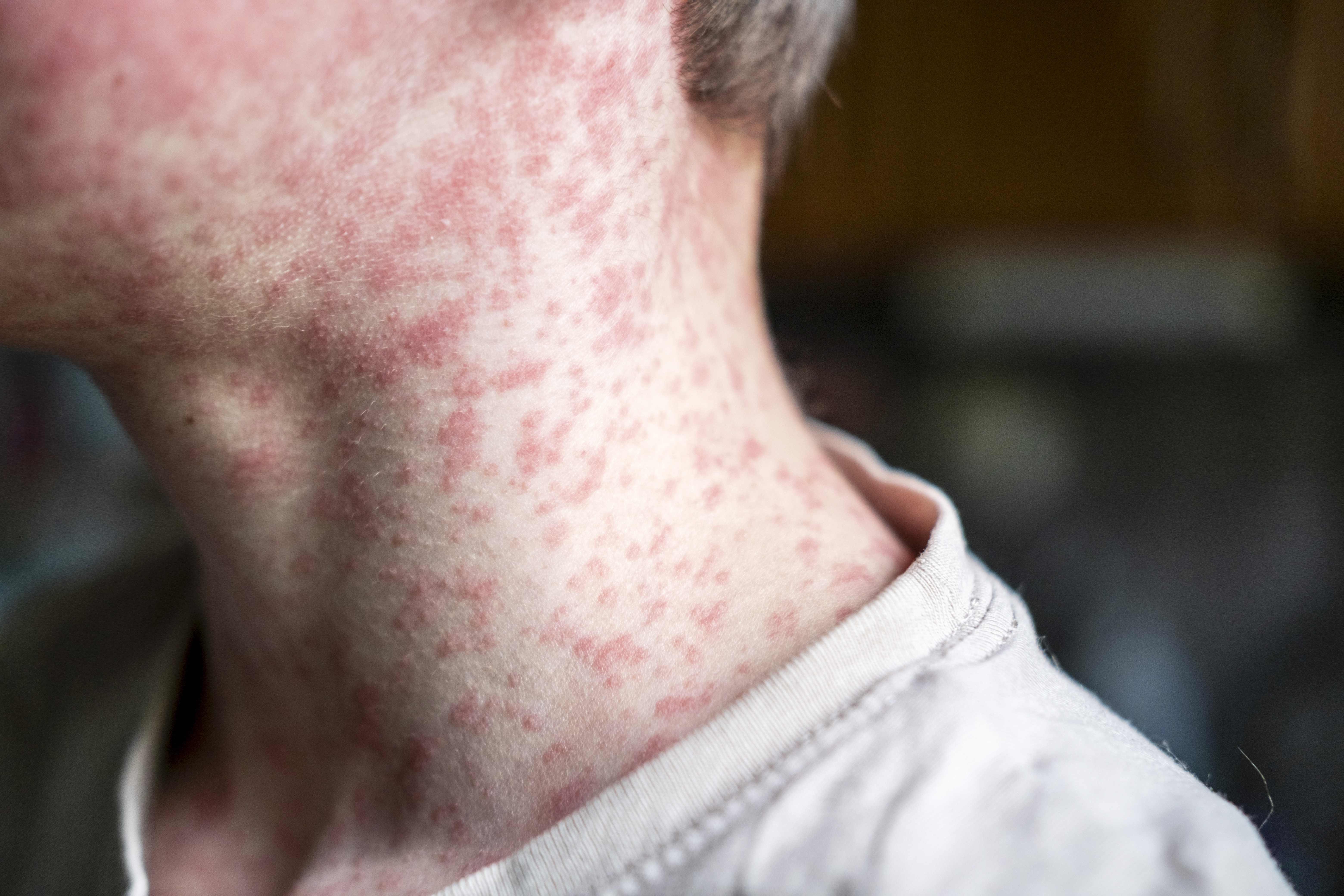 North Carolina reports 15 measles cases since December